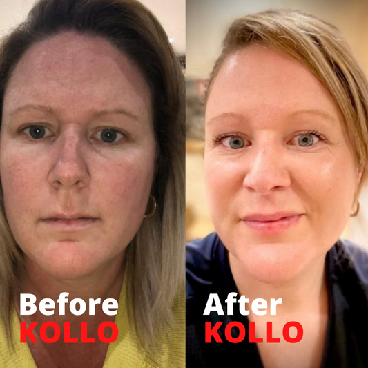  Collagen Lift Before and After Photos 