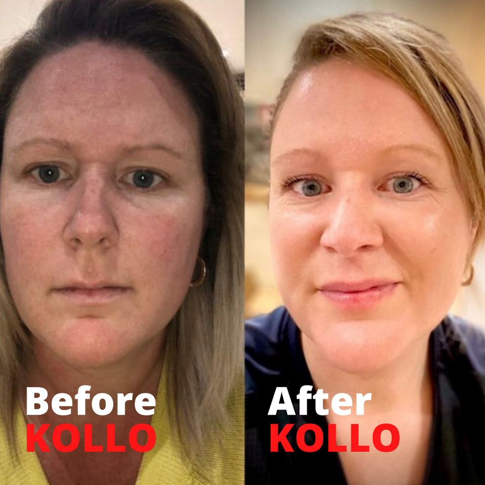 Collagen Lift Before and After Photos