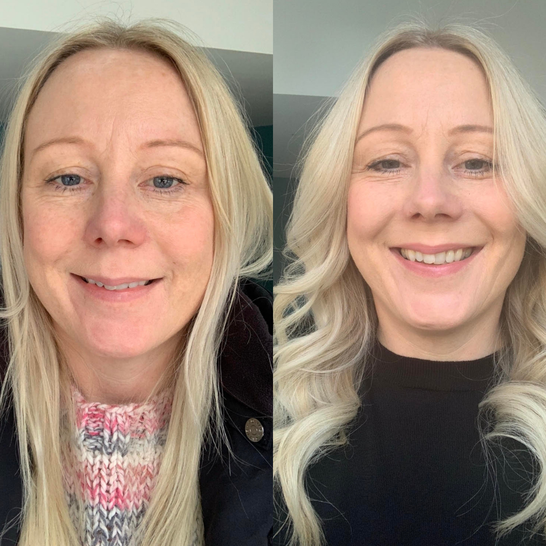 Collagen lift before and after 