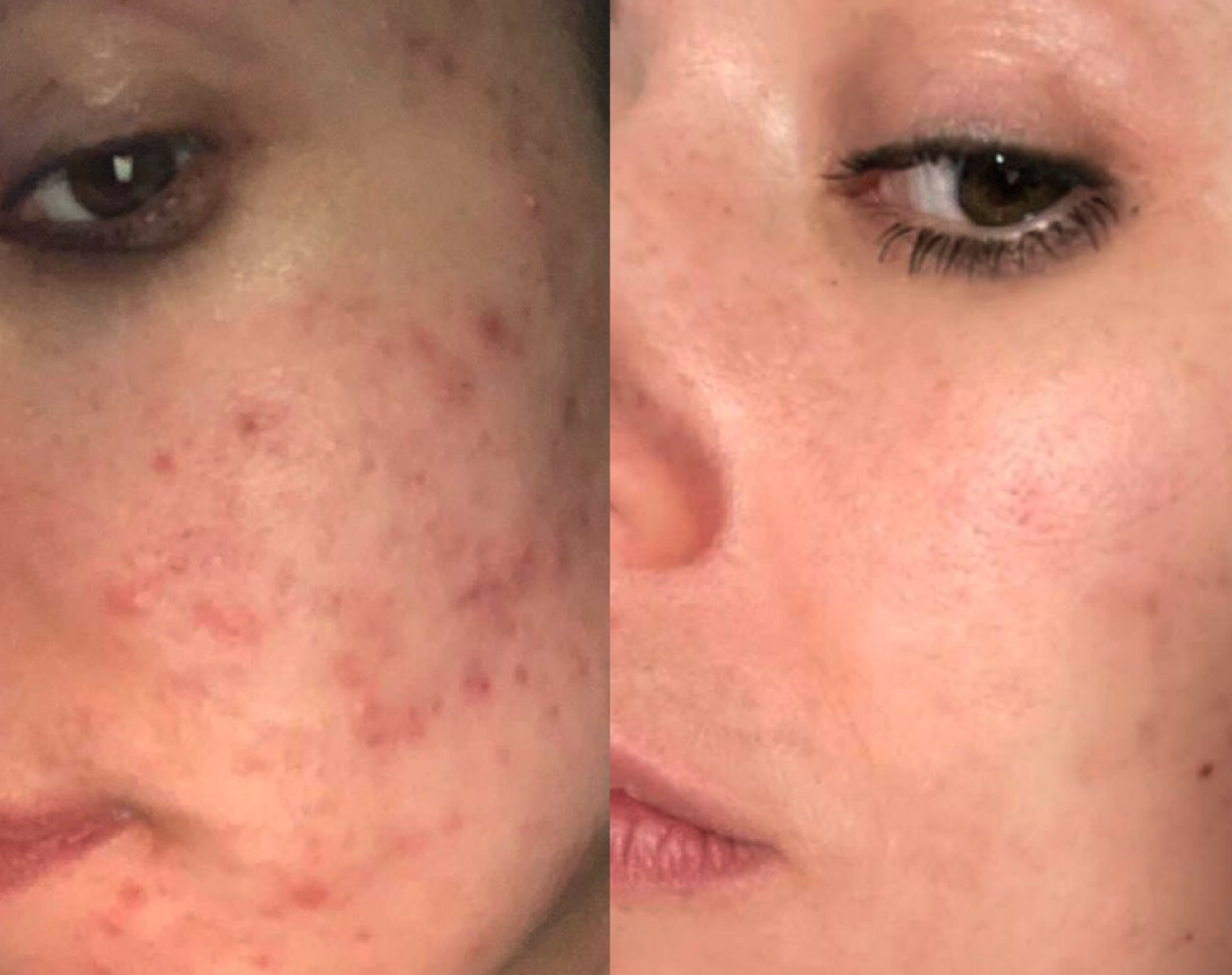 acne cure, spots, collagen supplement