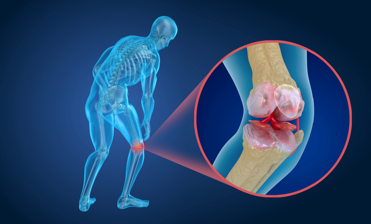 Benefits of collagen as a natural treatment for osteoporosis