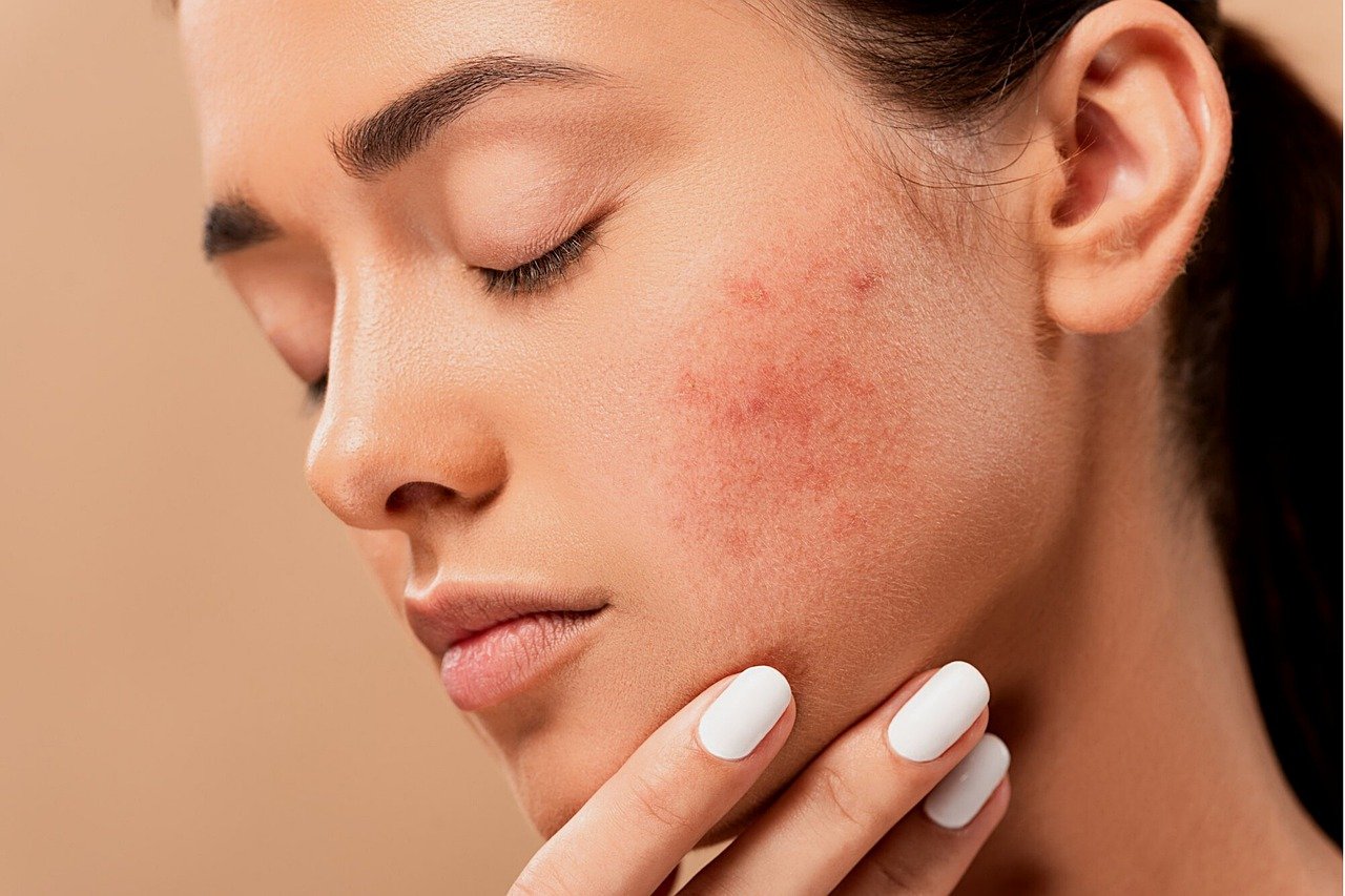 How collagen can help to beat acne