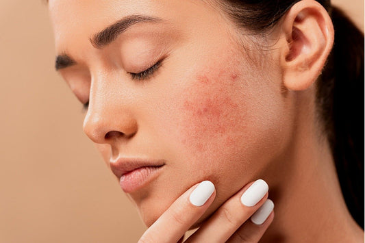  How collagen can help to beat acne 