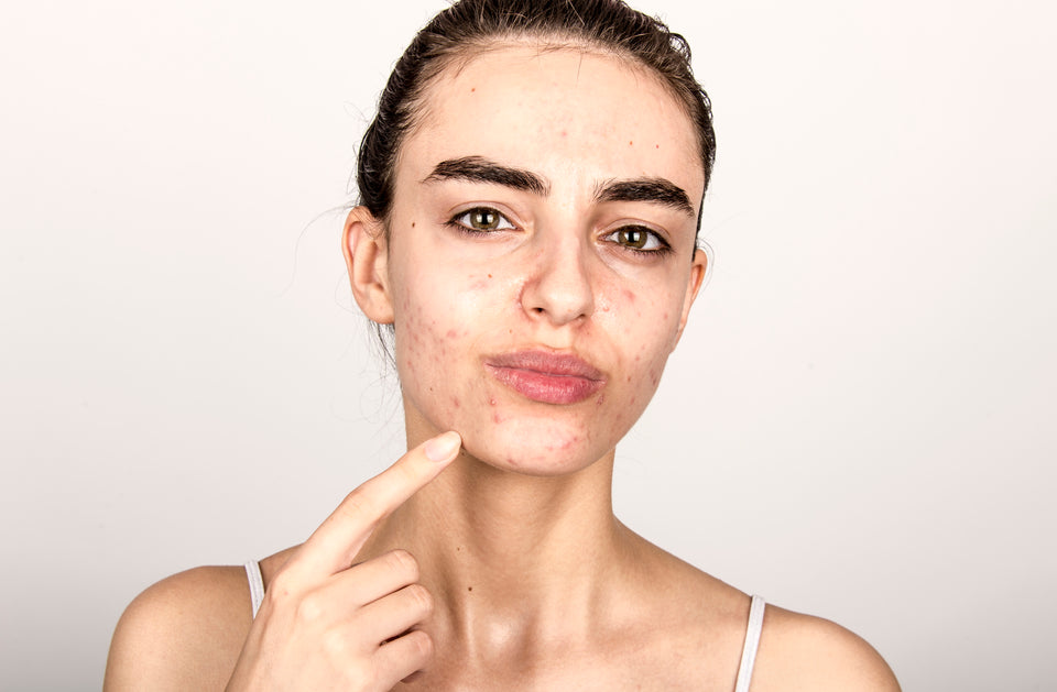How can marine collagen stop acne in its tracks?